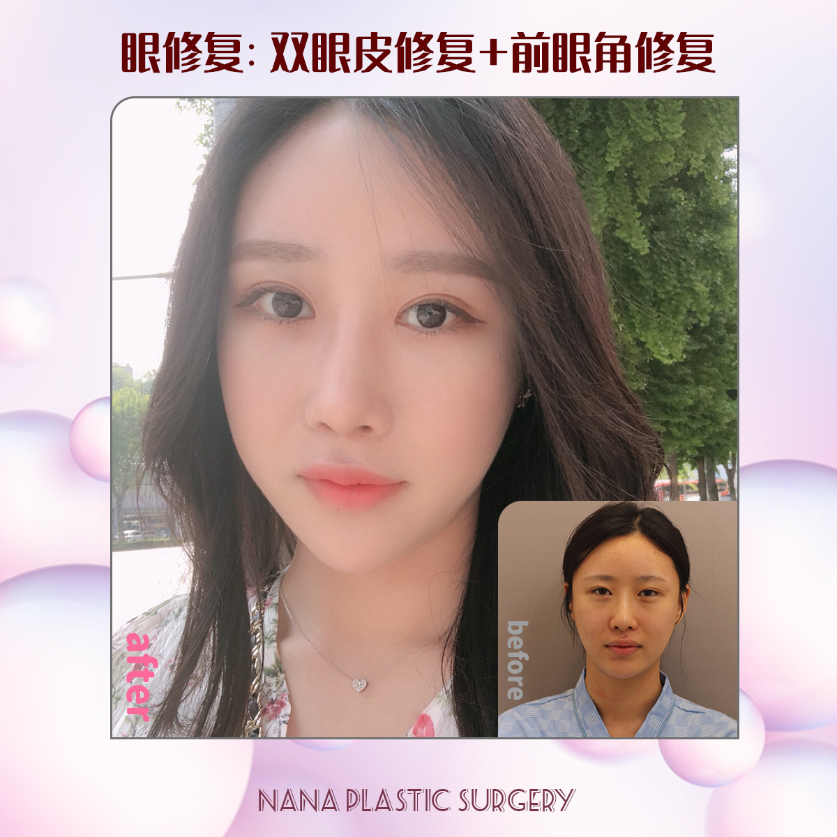 韩国nana整容医院为什么要去韩国做双眼皮手术呢