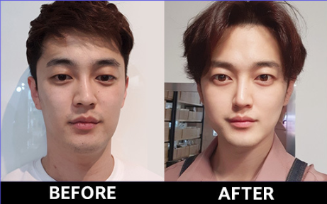 男士整形的偏见就是 娘 韩国整容整形 男士隆鼻