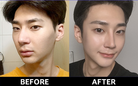 男士整形的偏见就是 娘 韩国整容整形 男士隆鼻