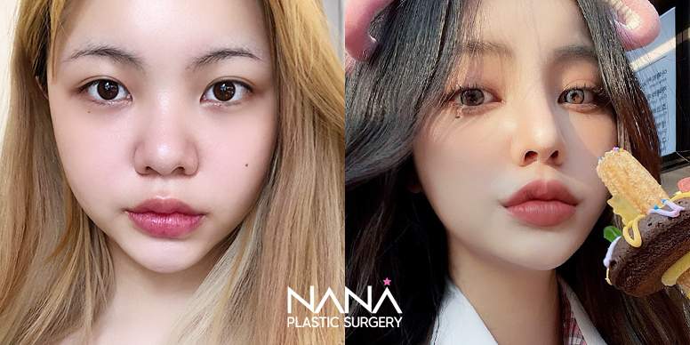 韩国nana整形外科 容貌焦虑症 大可不必 毕业变美季 钜惠来袭